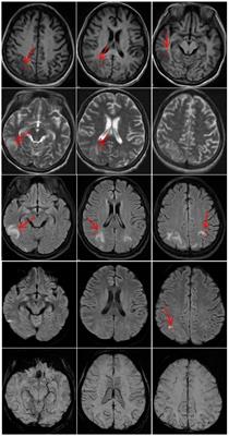 A case report of acute intermittent porphyria leading to severe disability